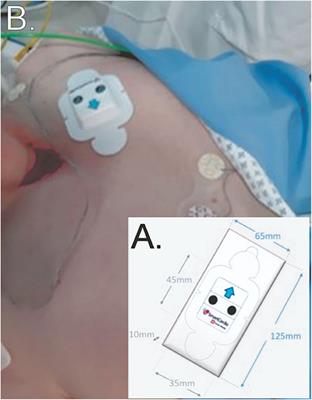 Cardiac Ambulatory Monitoring: New Wireless Device Validated Against Conventional Holter Monitoring in a Case Series